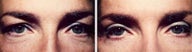 Eyelid Surgery