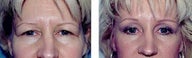 Eyelid Surgery