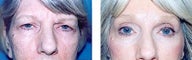 Eyelid Surgery