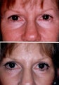 Blepharoplasty