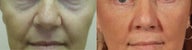 Blepharoplasty
