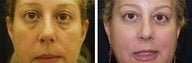 48 years old / upper and lower eye lids with lower lid fat transpositioning