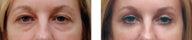 Blepharoplasty
