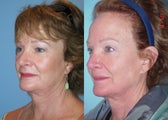 Upper Eyelid Surgery (Blepharoplasty)