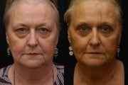 Blepharoplasty - upper and lower (Eyelid Surgery)