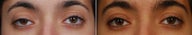 Right revision ptosis repair
