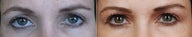 Right revision ptosis repair