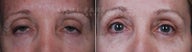 bilateral upper eyelid blepharoplasty and ptosis repair