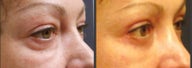 Upper & Lower eyelid surgery