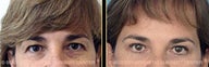 Eyelid Surgery
