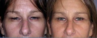 Upper blepharopasy or upper eyelid surgery and brawlift procedures.