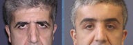 Upper blepharopasy or upper eyelid surgery and brawlift procedures.