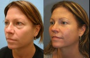 Eyelid Surgery