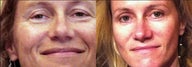 Blepharaoplasty