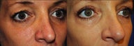 Blepharaoplasty