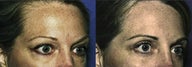 Blepharaoplasty