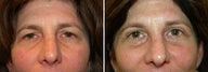 Blepharoplasty