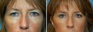 Blepharoplasty
