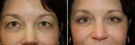 Blepharoplasty