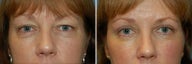 Blepharoplasty