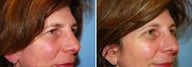 Blepharoplasty