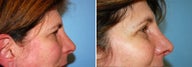 Blepharoplasty