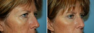 Blepharoplasty