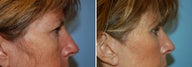Blepharoplasty