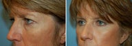 Blepharoplasty