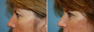 Blepharoplasty
