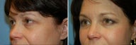 Blepharoplasty