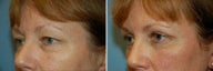 Blepharoplasty