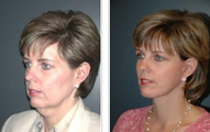 Facelift