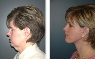 Facelift
