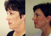 Facelift