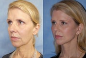 Facelift