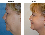 Facelift