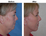Facelift
