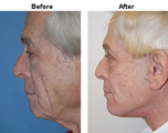 Facelift