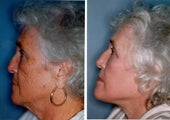Facelift