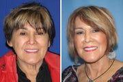 Facelift