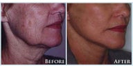 Facelift