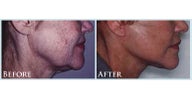 facelift