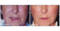 Facelift