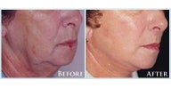 Facelift