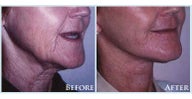Facelift