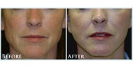Facelift