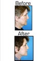 Facelift