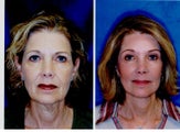 Facelift