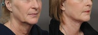 Facelift